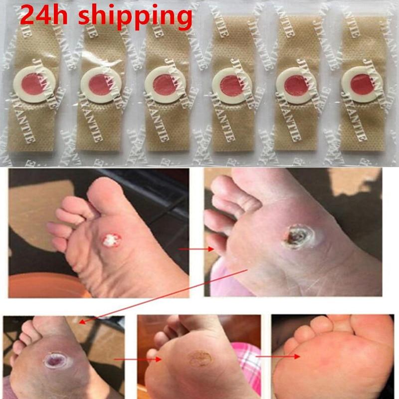 30pcs Foot Plaster Corn Removal Pads Medical Plasters Warts Thorn Patch Curative Patches Calluses Callosity Detox Foot Patches - GoJohnny437